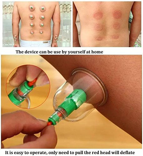 12 PIS SET VACUUM ACUPUNCTURE CUPPING